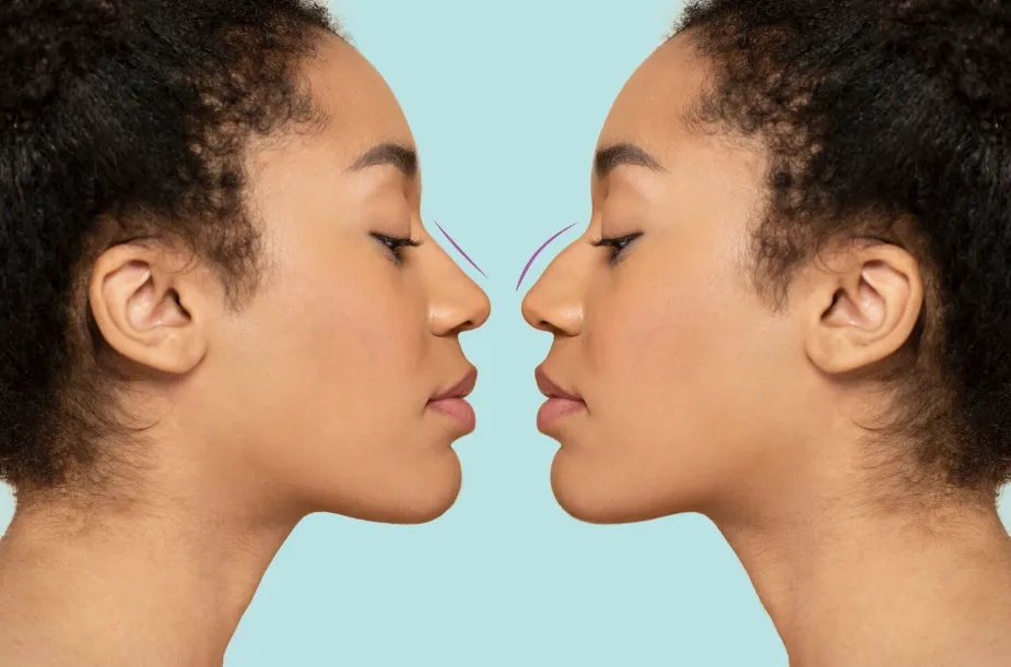 Real Septorhinoplasty Before and After Results How Nose Shape and Breathing Improve Together